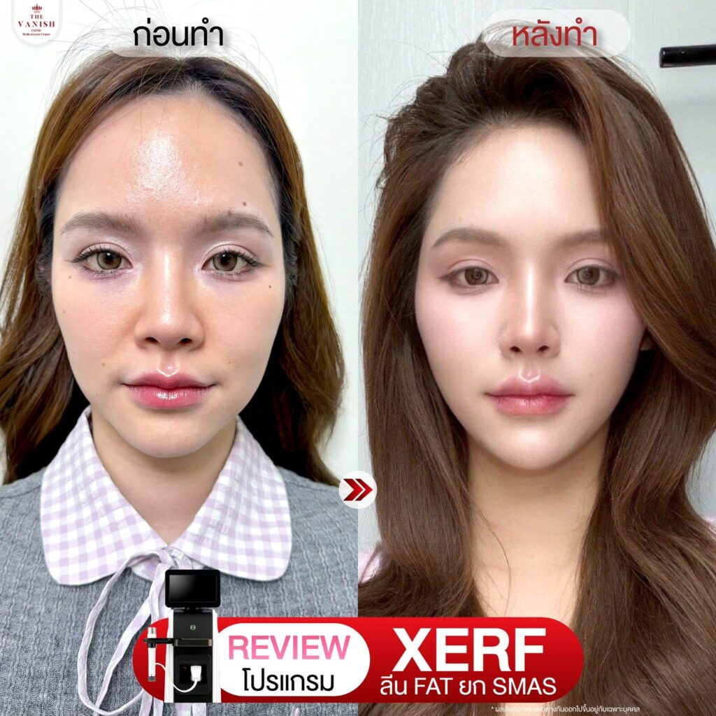 รีวิวโปรแกรม XERF ที่ The Vanish Clinic จากคนไข้จริง