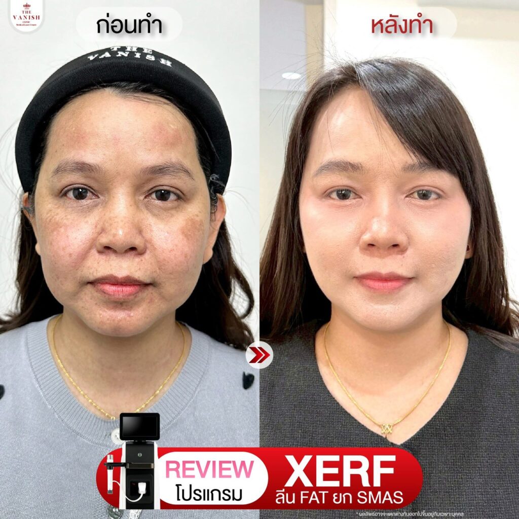 รีวิวโปรแกรม XERF ที่ The Vanish Clinic จากคนไข้จริง