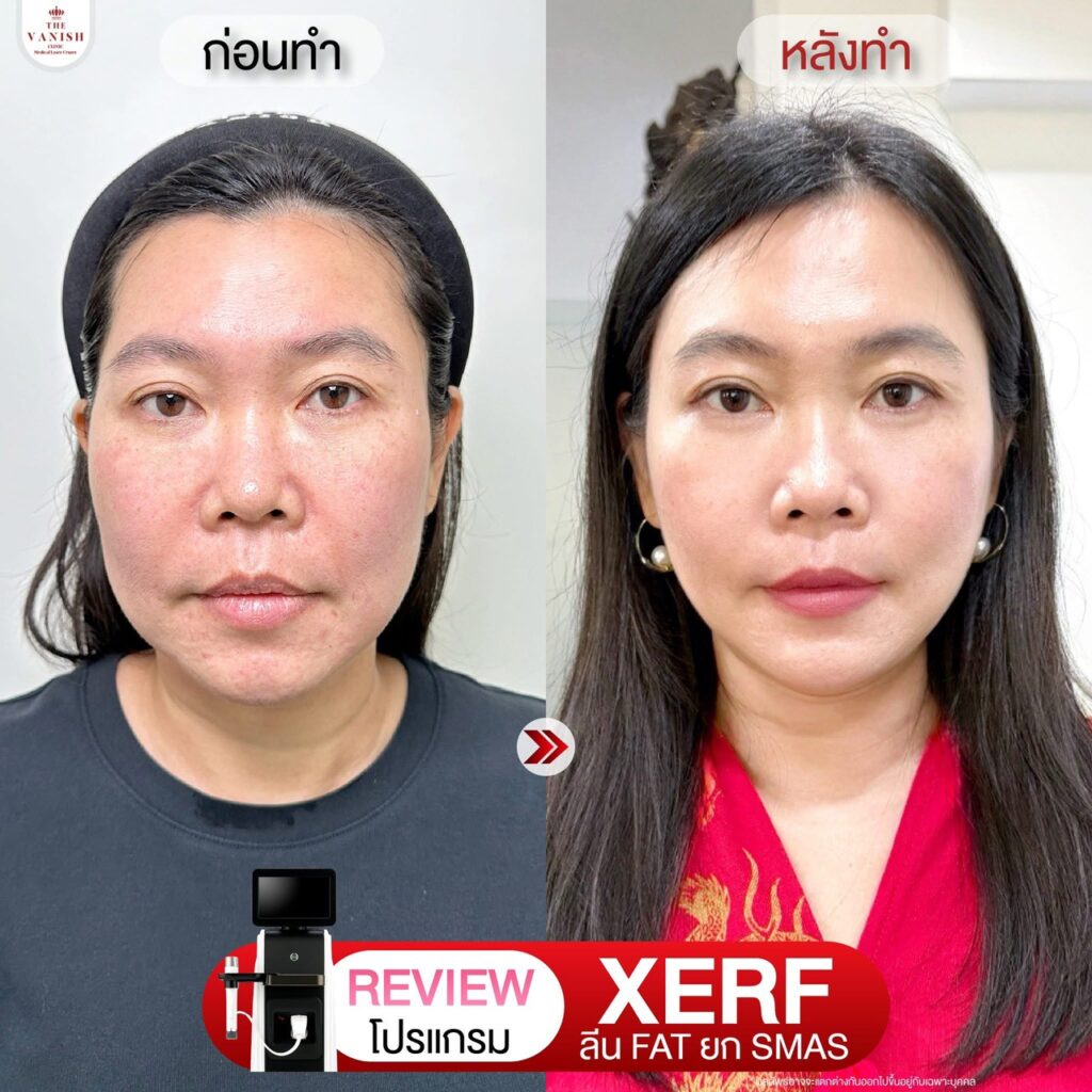 รีวิวโปรแกรม XERF ที่ The Vanish Clinic จากคนไข้จริง