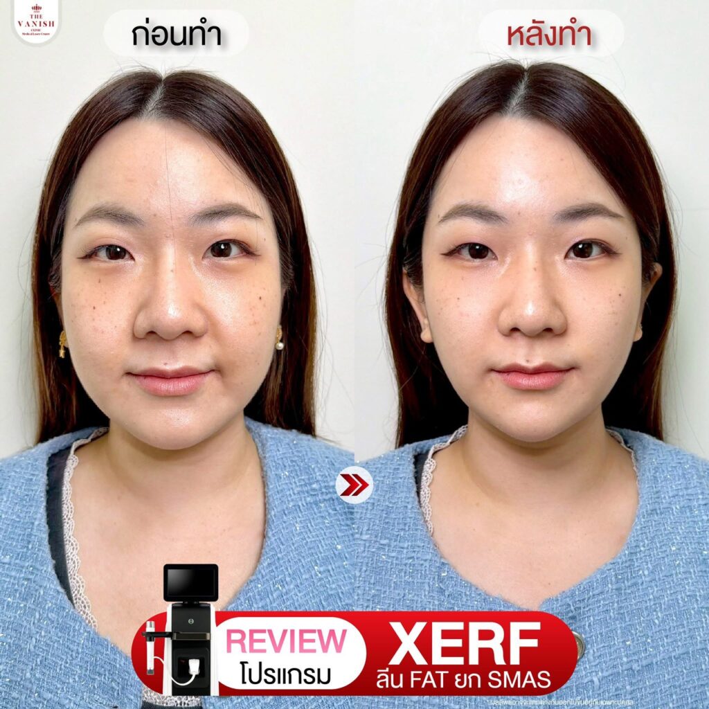 รีวิวโปรแกรม XERF ที่ The Vanish Clinic จากคนไข้จริง