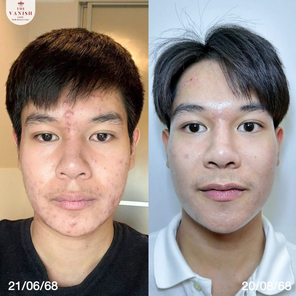 รีวิวทำ RejuAc ที่ The Vanish Clinic