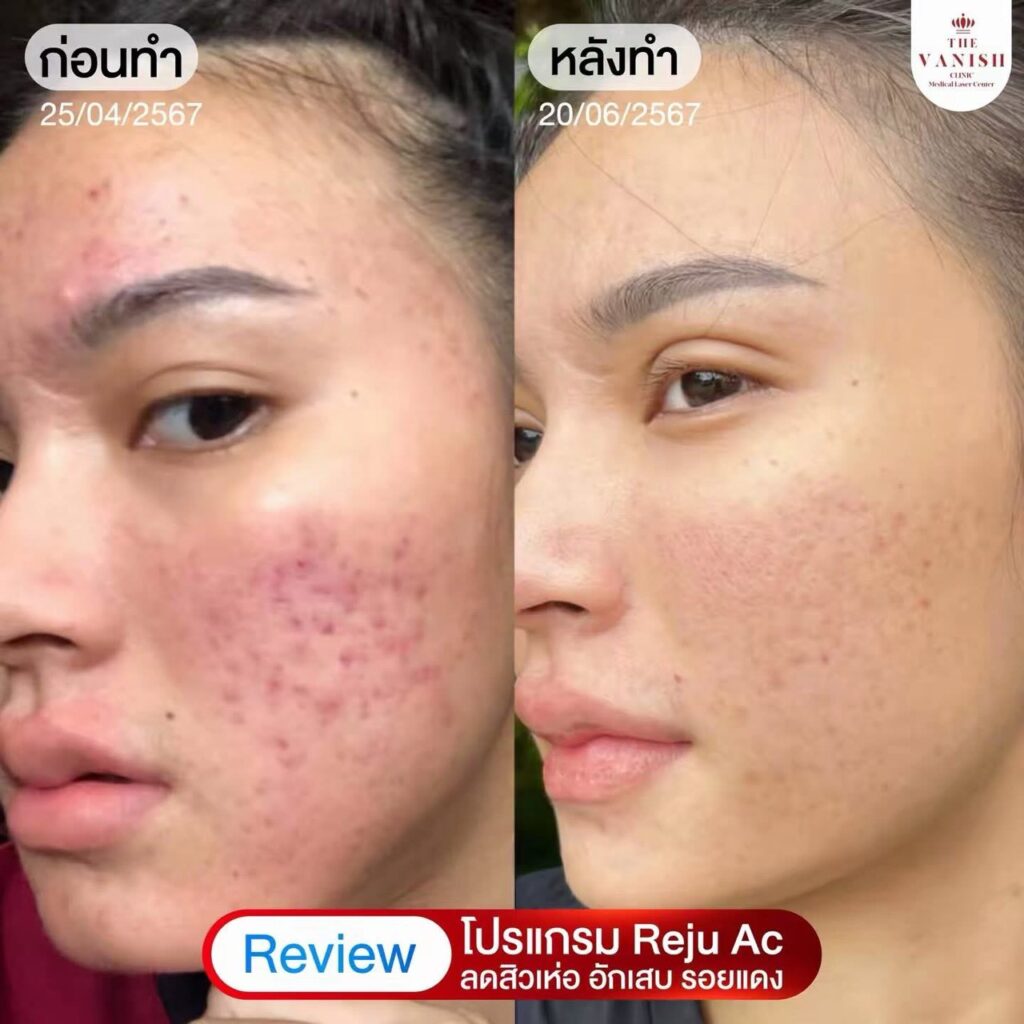 รีวิวทำ RejuAc ที่ The Vanish Clinic