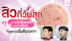 สิวกี่วันสุก สรุปขั้นตอนของการเกิดสิวจนหาย