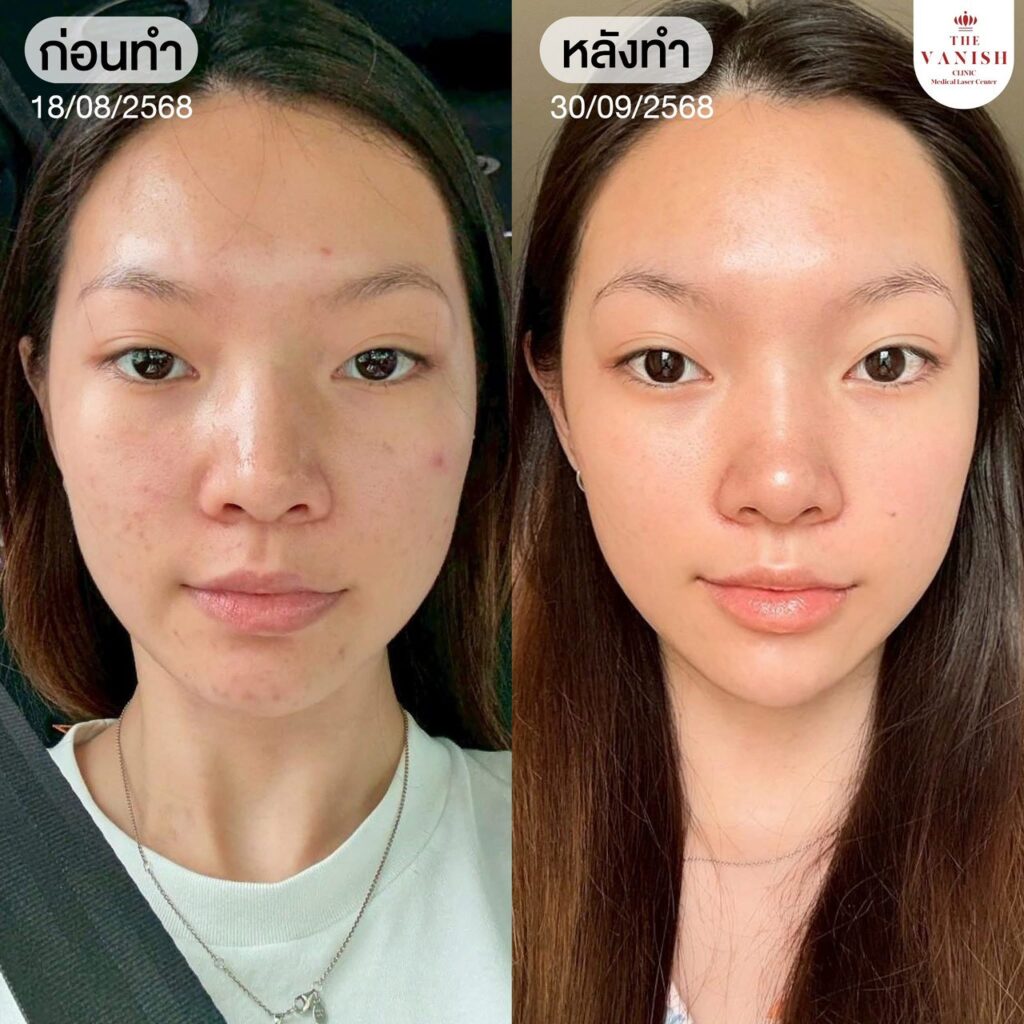 รีวิว NeoAc และ RejuAc โปรแกรมฉีดสิวที่ The Vanish Clinic
