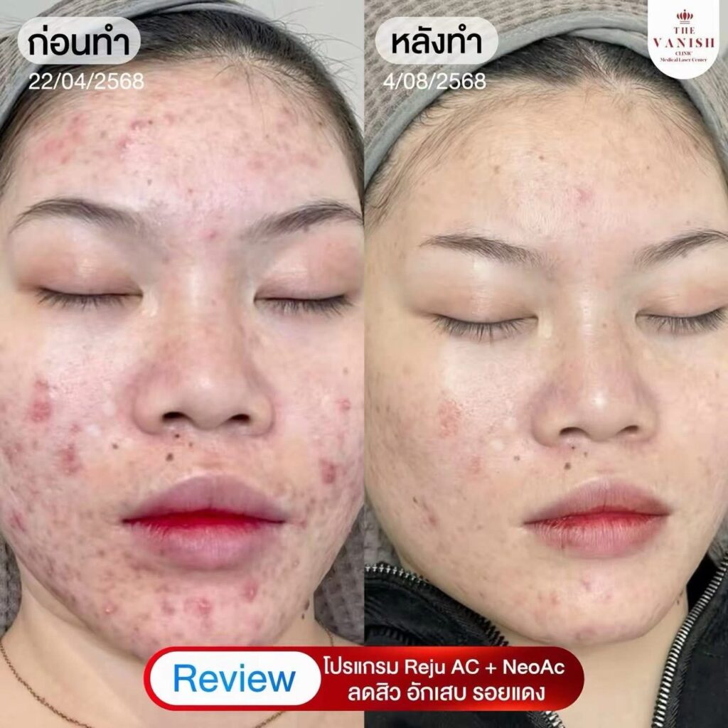 รีวิวทำ RejuAc ที่ The Vanish Clinic