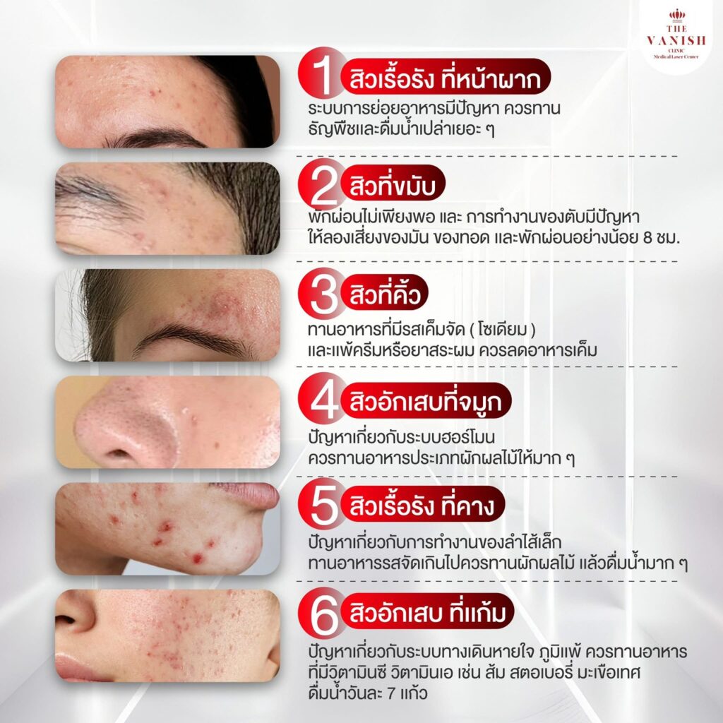 สิวอักเสบหัวหนอง พบบ่อยที่บริเวณไหนบ้าง