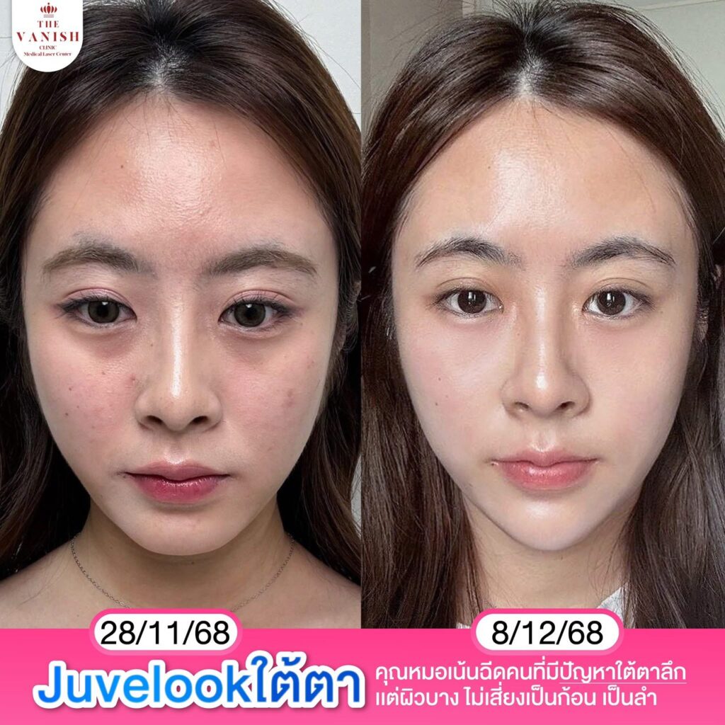 รีวิว Skin Booster Juvelook ใต้ตา