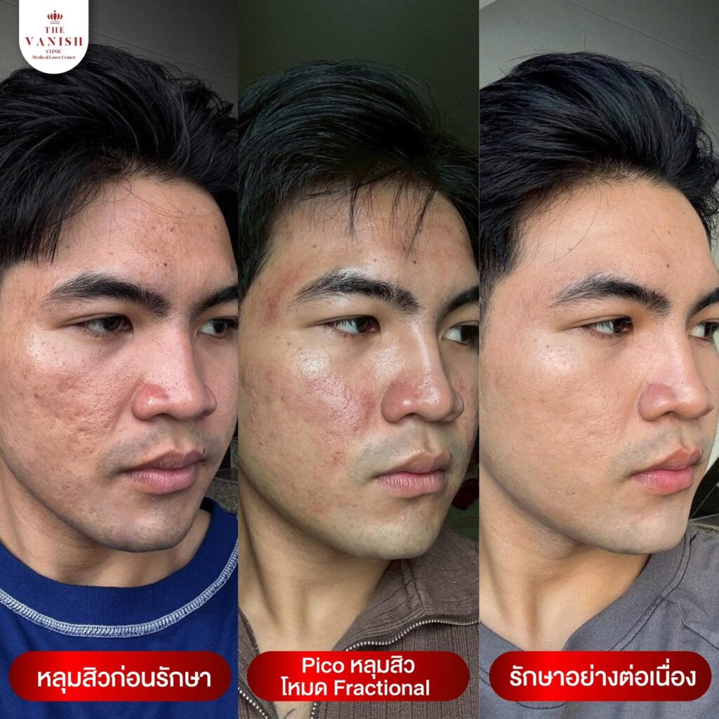 รีวิวหัตถการ PICO Laser ช่วยบรรเทาจุดด่างดำ รอยสิว