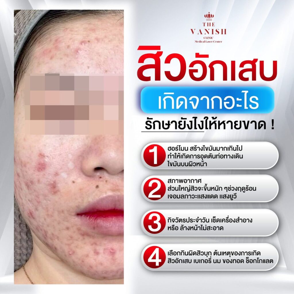 สิวอักเสบเกิดจากอะไร