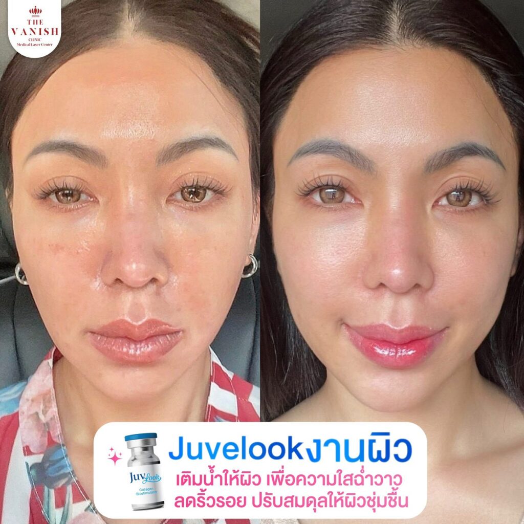 รีวิว Skin Booster Juvelook งานผิว