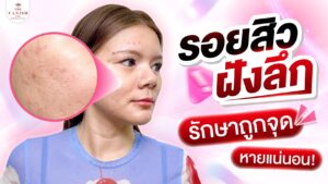 คู่มือรักษาจุดด่างดําจากสิว สำหรับผู้ที่อยากให้รอยสิวจางจริง