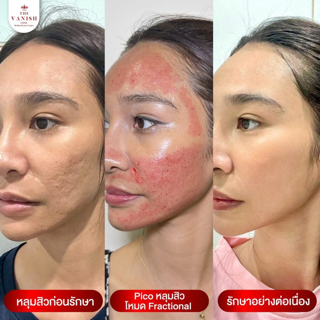 รีวิวหัตถการ PICO Laser ช่วยบรรเทาจุดด่างดำ รอยสิว