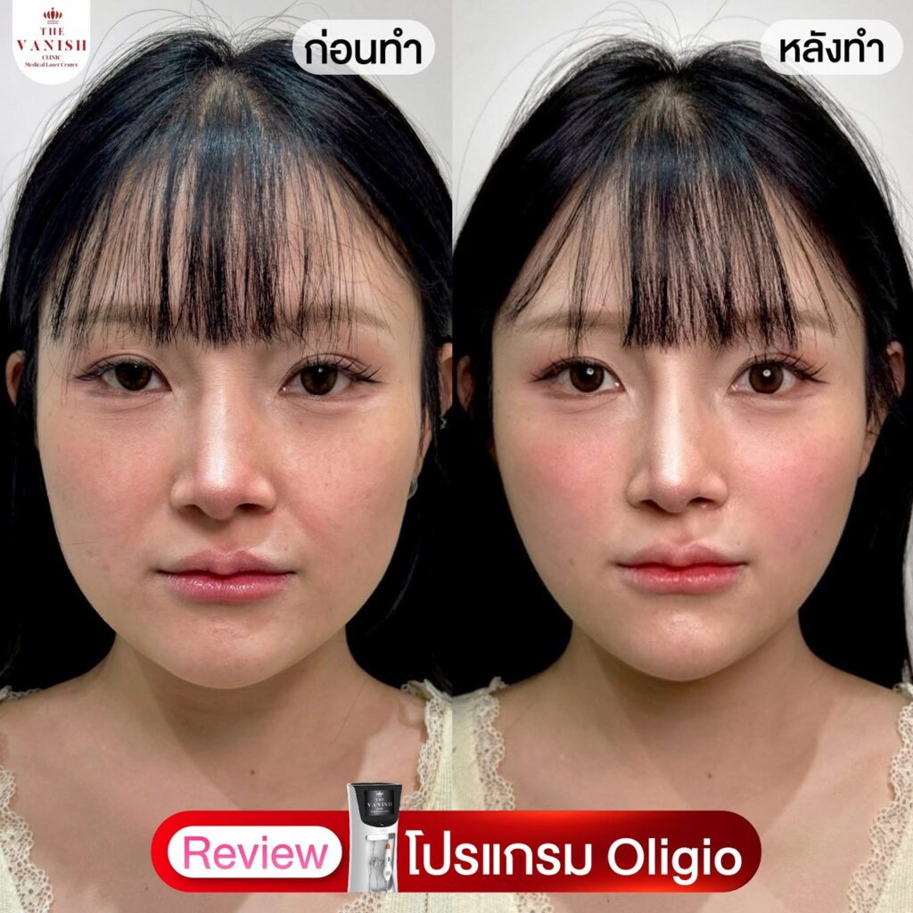 รีวิว Oligio – กระชับผิวชั้นตื้น