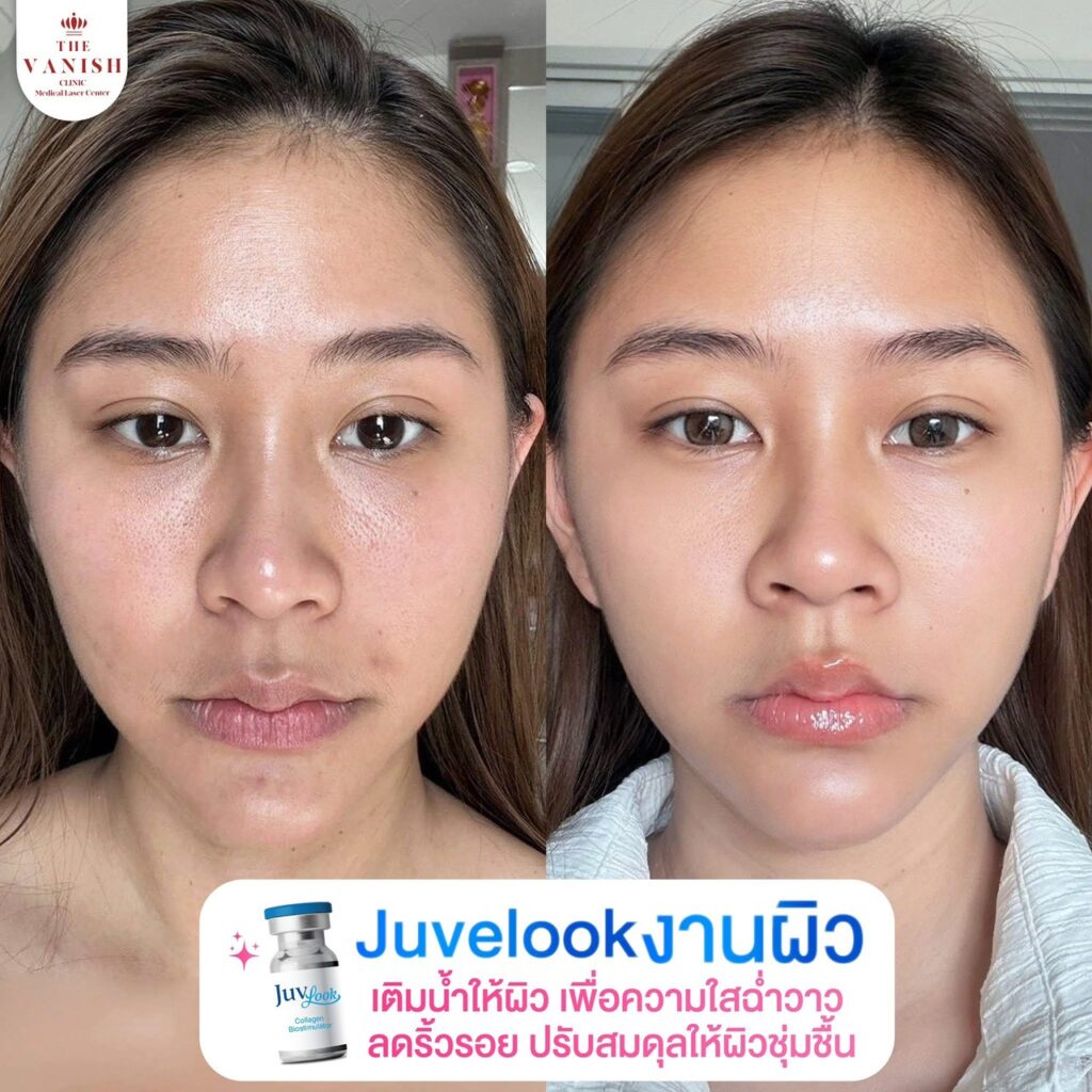 รีวิว ทำ Biostimulator อย่างการฉีด Juvelook ที่ The Vanish Clinic