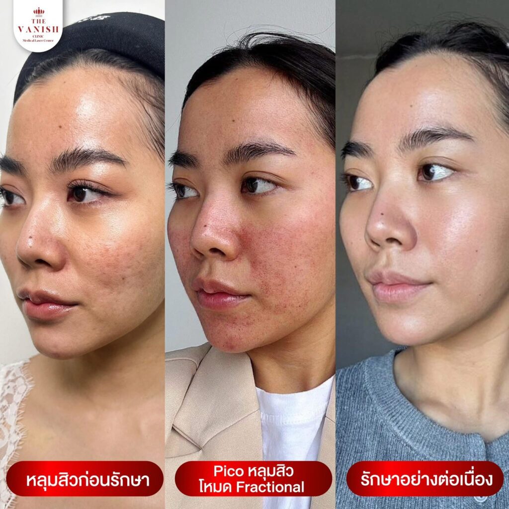 รีวิวหัตถการ PICO Laser ช่วยบรรเทาจุดด่างดำ รอยสิว