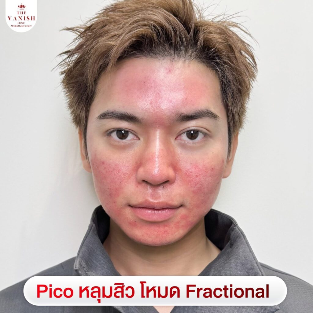 รีวิวหัตถการ PICO Laser โหมด Fractional ช่วยบรรเทาจุดด่างดำ รอยสิว