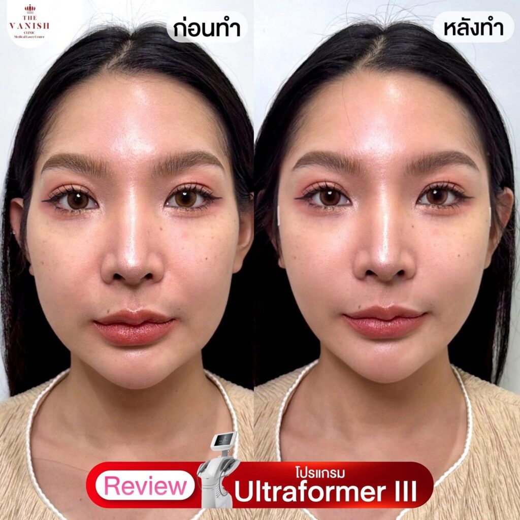 รีวิว Ultraformer III – ยกกระชับชั้นลึก ให้กรอบหน้าชัดขึ้น