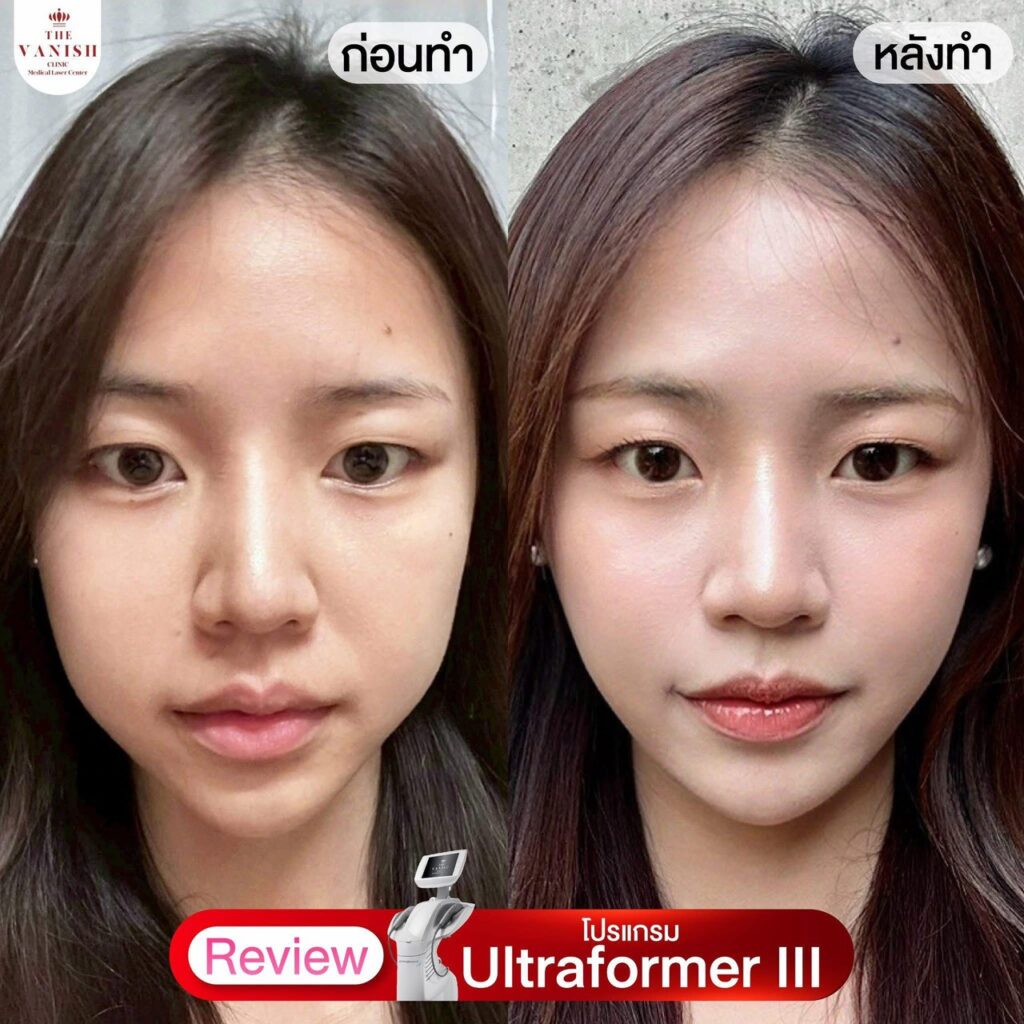 รีวิว Ultraformer III – ยกกระชับชั้นลึก ให้กรอบหน้าชัดขึ้น