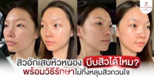 สิวอักเสบหัวหนอง บีบสิวได้ไหม? พร้อมวิธีรักษาให้หายไว ไม่ทิ้งหลุมสิวกวนใจ