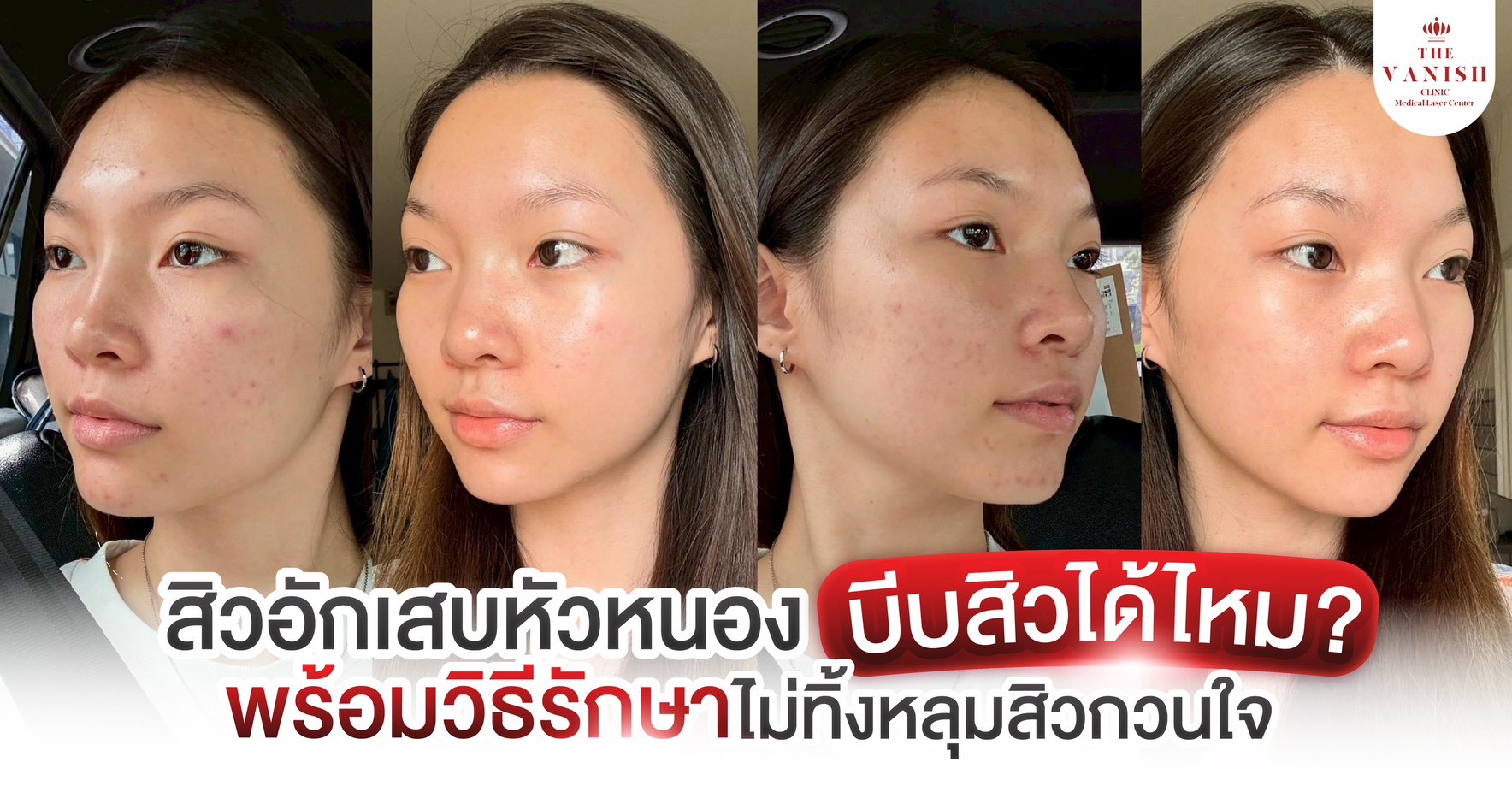 สิวอักเสบหัวหนอง บีบสิวได้ไหม? พร้อมวิธีรักษาให้หายไว ไม่ทิ้งหลุมสิวกวนใจ