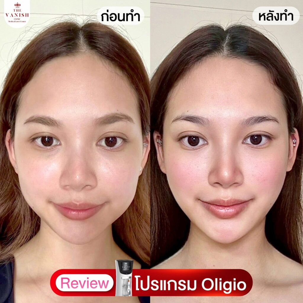 รีวิว Oligio – กระชับผิวชั้นตื้น