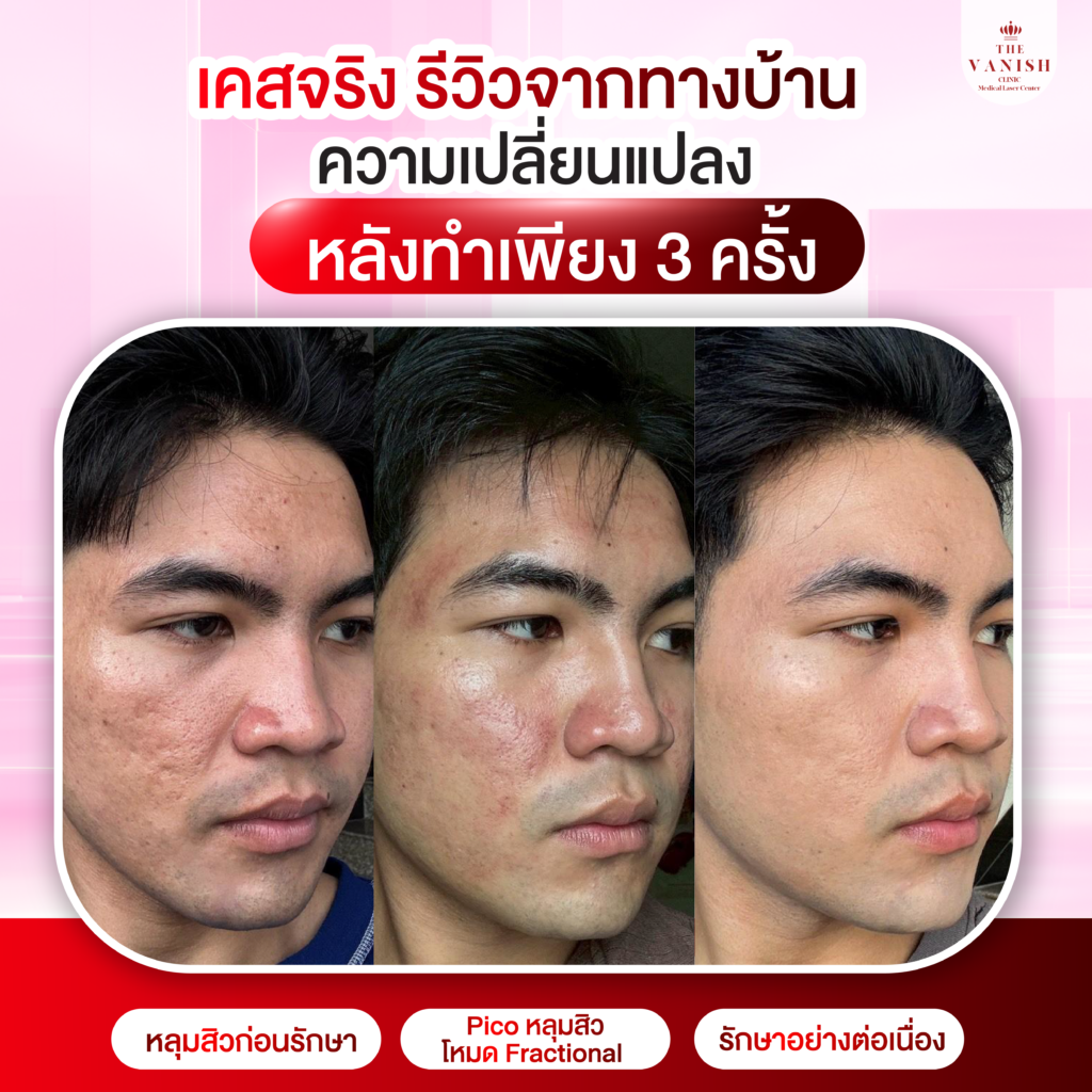 รีวิวหัตถการ PICO Laser และ Discovery PICO จาก The Vanish Clinic
