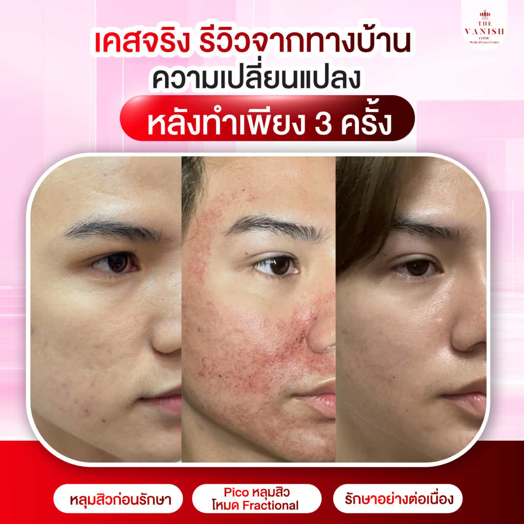 รีวิวหัตถการ PICO Laser และ Discovery PICO จาก The Vanish Clinic