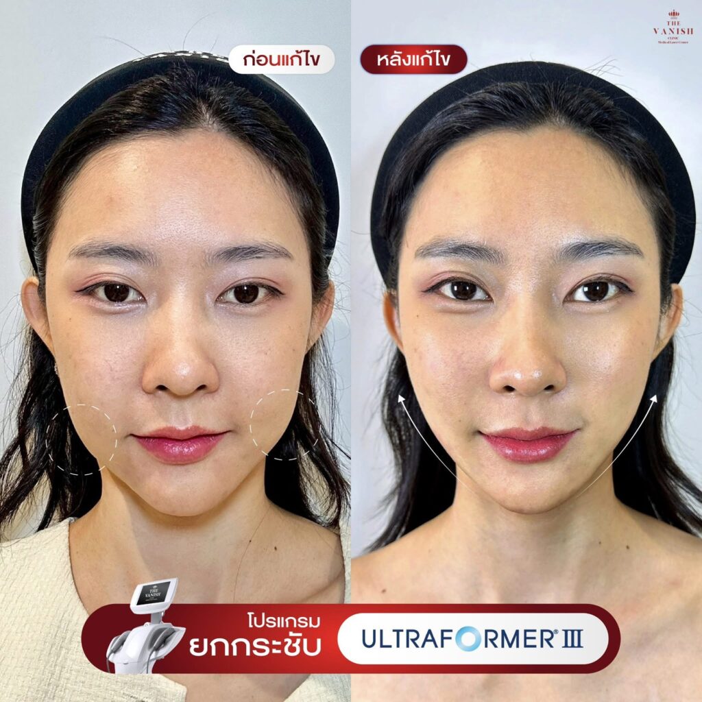รีวิว Ultraformer MPT