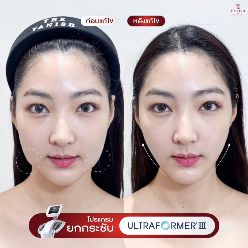 รีวิว Ultraformer MPT