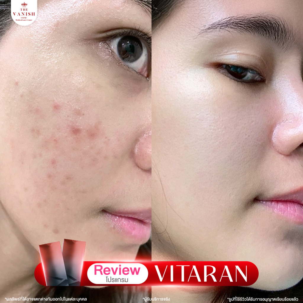 รีวิวทำหัตถการโปรแกรม Vitaran กับ The Vanish Clinic จากลูกค้าจริง