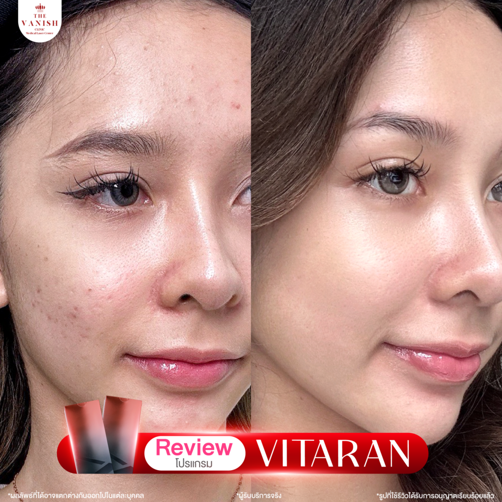 รีวิวทำหัตถการโปรแกรม Vitaran กับ The Vanish Clinic จากลูกค้าจริง