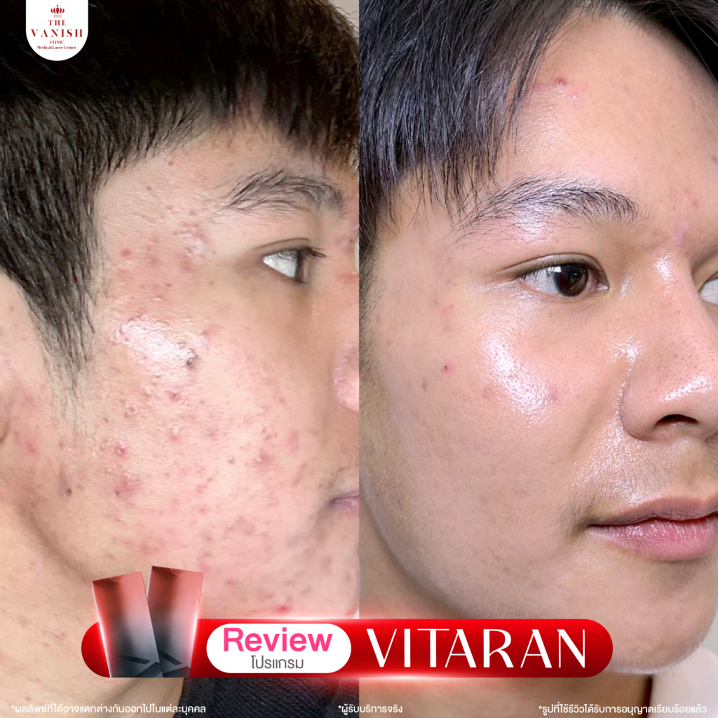 รีวิวทำหัตถการโปรแกรม Vitaran กับ The Vanish Clinic จากลูกค้าจริง