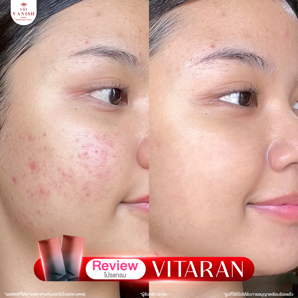 รีวิวทำหัตถการโปรแกรม Vitaran กับ The Vanish Clinic จากลูกค้าจริง