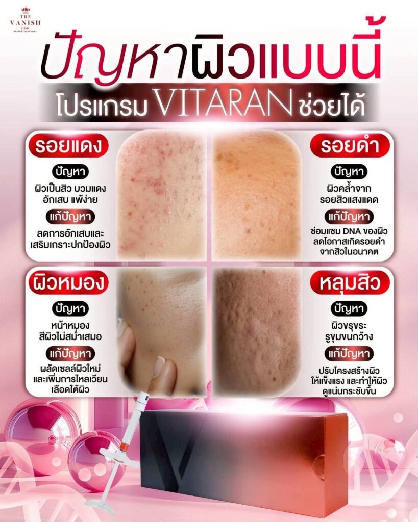 โปรแกรม Vitaran ช่วยเรื่องปัญหาผิวอะไรบ้าง