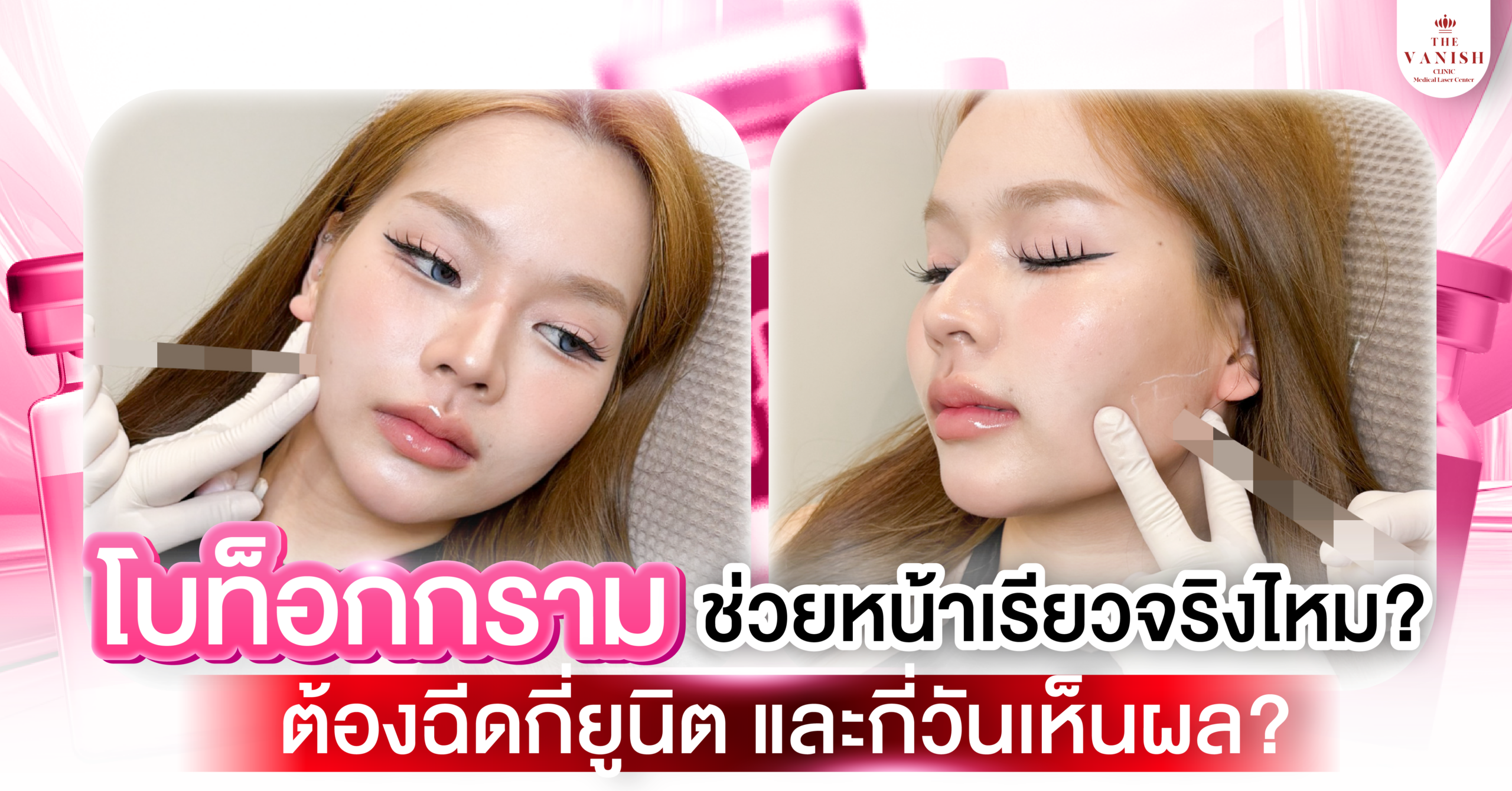 โบท็อกกรามช่วยหน้าเรียวจริงไหม ต้องฉีดกี่ยูนิต และกี่วันเห็นผล?